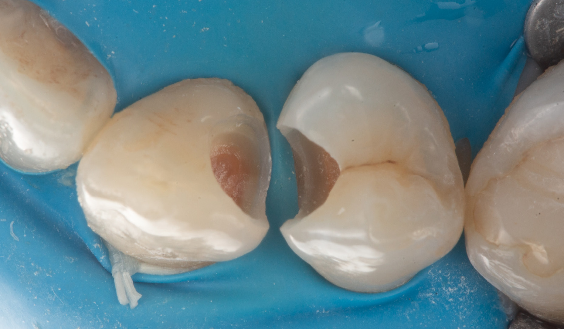 Fig. 3: Refined cavities with a deep margin on the premolar